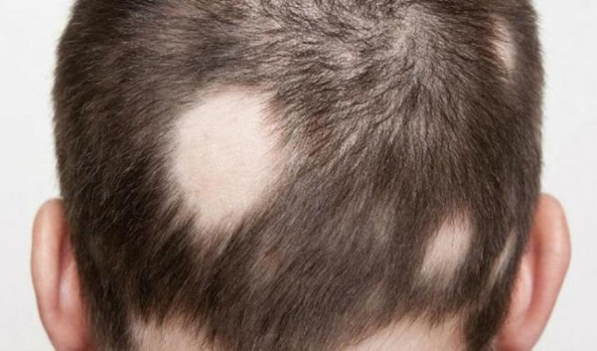 Saçkıran (Alopesi Areata)
